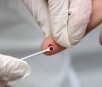 Teste rápido de HIV: onde fazer e como funciona