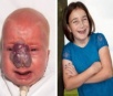 Menina tem nariz reconstruído após marca de nascença quase a matar sufocada