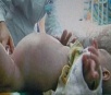 Menino de dois anos passa por cirurgia de gravidez