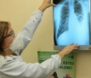 Saúde intensifica ações para o combate à tuberculose em Dourados