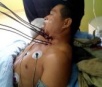 Homem sobrevive após perfurar pescoço com sete barras de metal.
