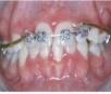 Investigação associa apneia em crianças à má formação dentária