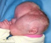Bebê com condição rara passa por cirurgia para evitar que cérebro fosse esmagado pelo crescimento da