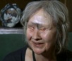 Mulher tem rosto desfigurado por cão e diz que animal salvou sua vida