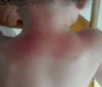 Protetor solar de marca argentina causa dermatite em crianças