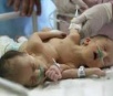 Gêmeas siamesas que nasceram no Estado morrem em hospital de Goiás