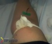 Precariedade: paciente fica 5 dias com hemorragia após enfermeiro  suspender aplicação  de soro ao v