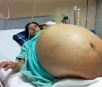 Tumor de 60 quilos é retirado de mulher no México