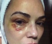 Foto mostra olho machucado de Luiza Brunet após agressão